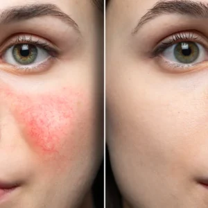 Before and after split face comparison demonstrating collagen serum benefits for anti wrinkle facial care and redness reduction