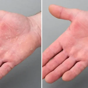 Before and after hand comparison showing dry skin vs moisturized soft skin after using moisturizing hand wash